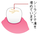 シーラント
